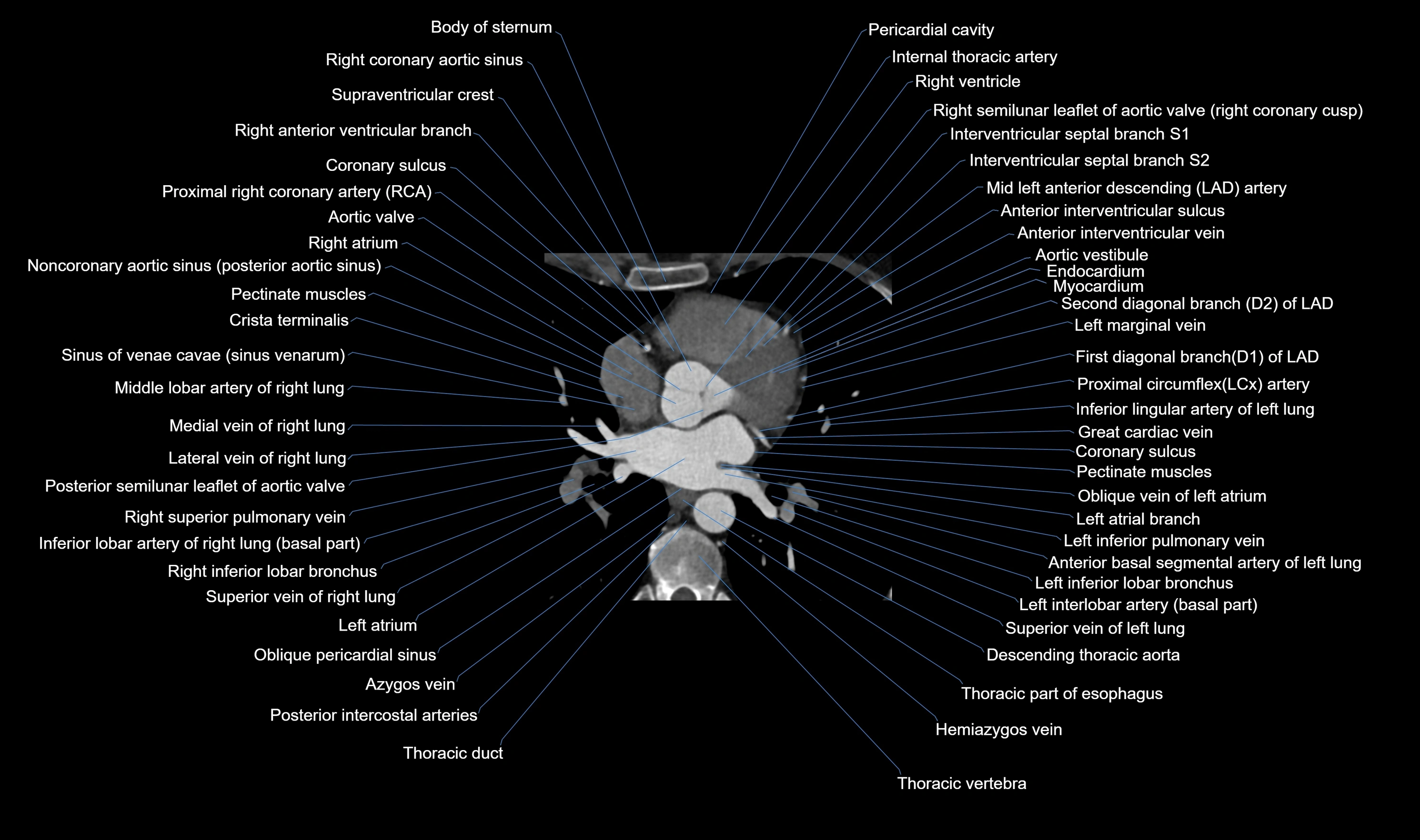 CT heart (coronary angiogram) axial view cross sectional anatomy labelled radiology image-00029.webp